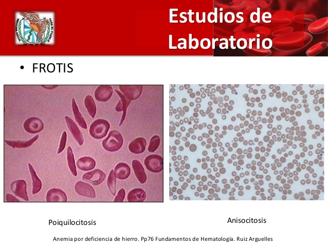 fundamentos hematologia ruiz arguelles pdf